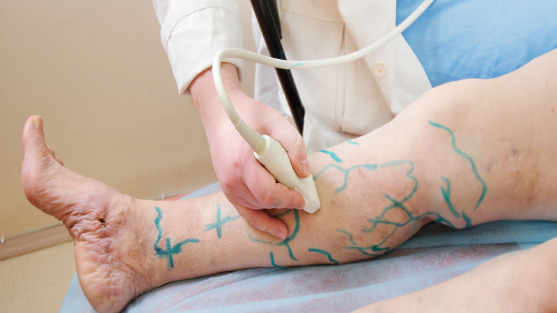 FAQs About Varicose Veins