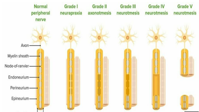 4 Types of Peripheral Nerve Surgery